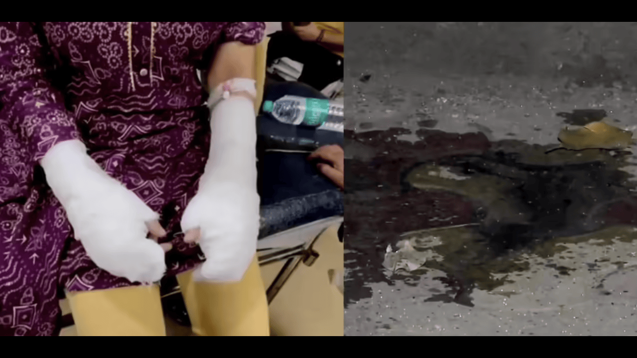 Delhi University girl attacked with acid in Ashok Vihar; police investigate.